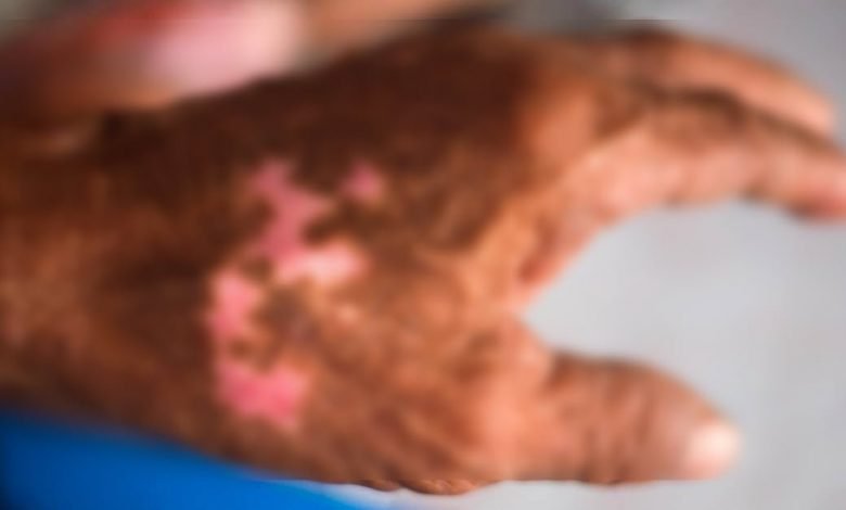 cüzzam hastalığı belirtileri nelerdir? https://huglero.com